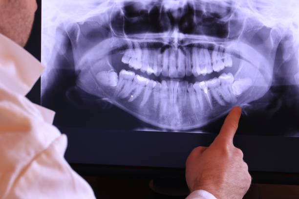 Best Knocked-Out Tooth (Avulsed Tooth) Treatment in Epworth, IA